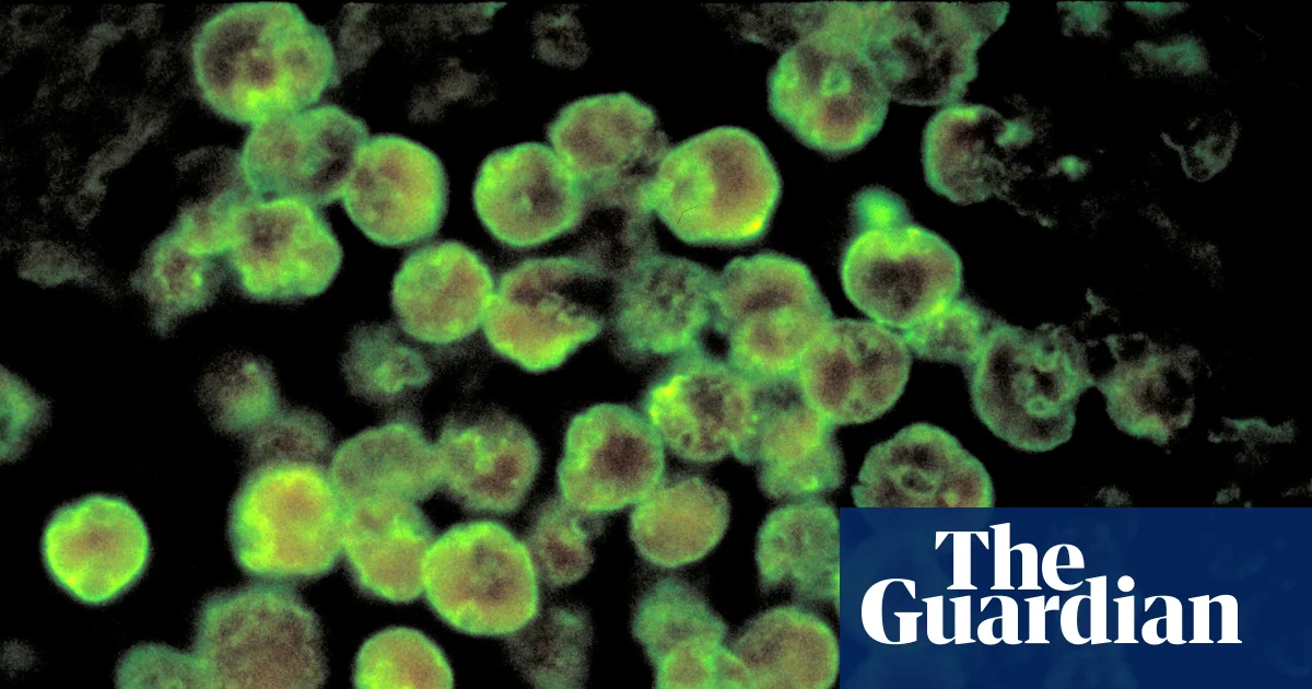 North Carolina teen dies from rare brain-eating amoeba infection