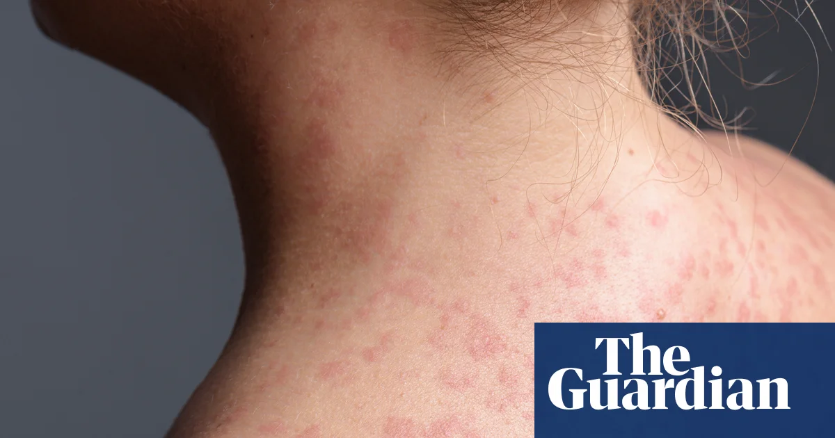 California warns of measles exposure in six counties from unvaccinated train passenger